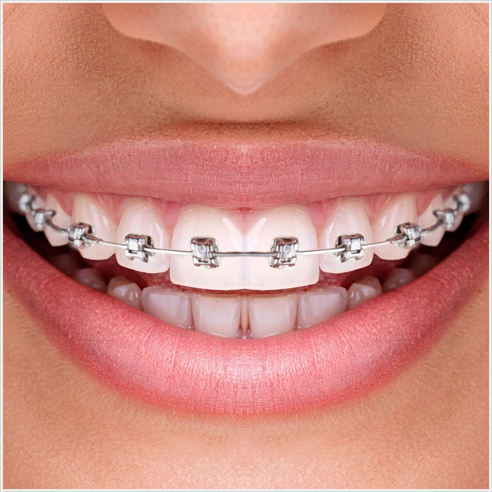 Ortodontik Caprasik Dis Tedavisi Ankara Dr Dt Omer Bayar