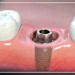 implant diş