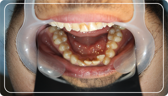 ortodontik çapraşık diş tedavisi