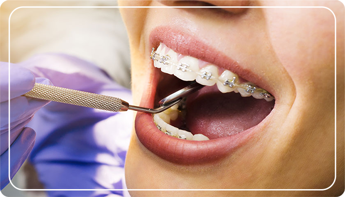 ortodontik tel tedavisi