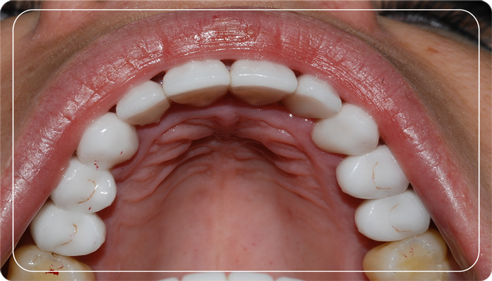 Diş temizletmek dişlere zarar verir mi?