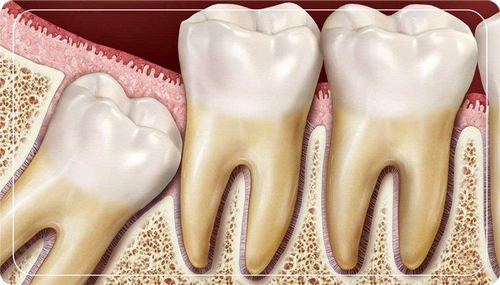 Gömülü dişlerin hepsi çekilmeli mi?